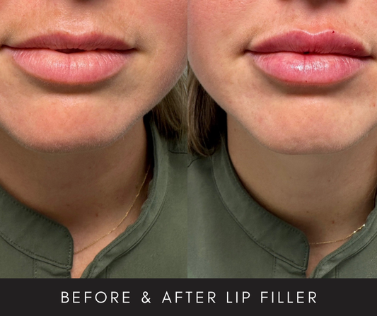 Revanesse – LIP FILLER